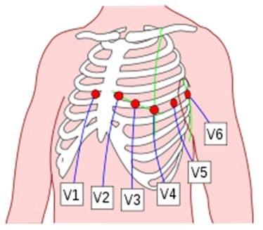 Figure 20: Placement of 6 chest leads.